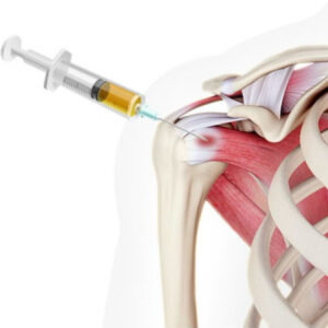 Plazmaterapia – PRP