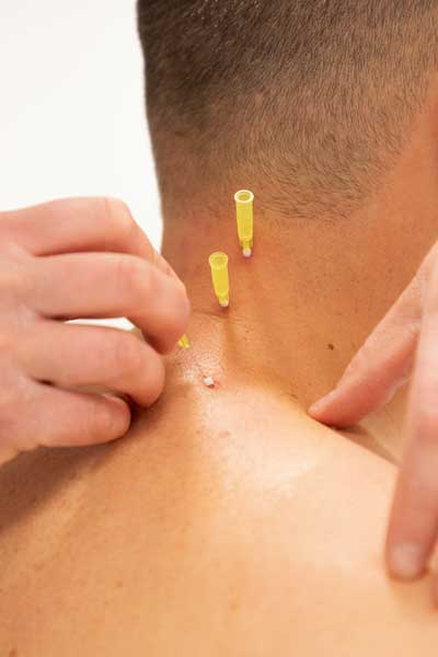 aplikacia bijou thread biodermalne niter ameno - Poprad